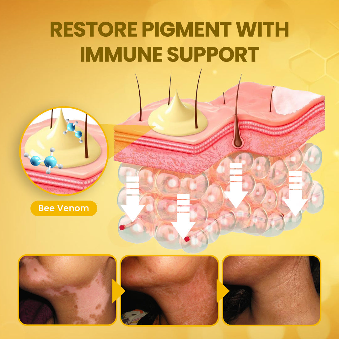 Timilk® NaturaViti Bee Venom Vitiligo Cream